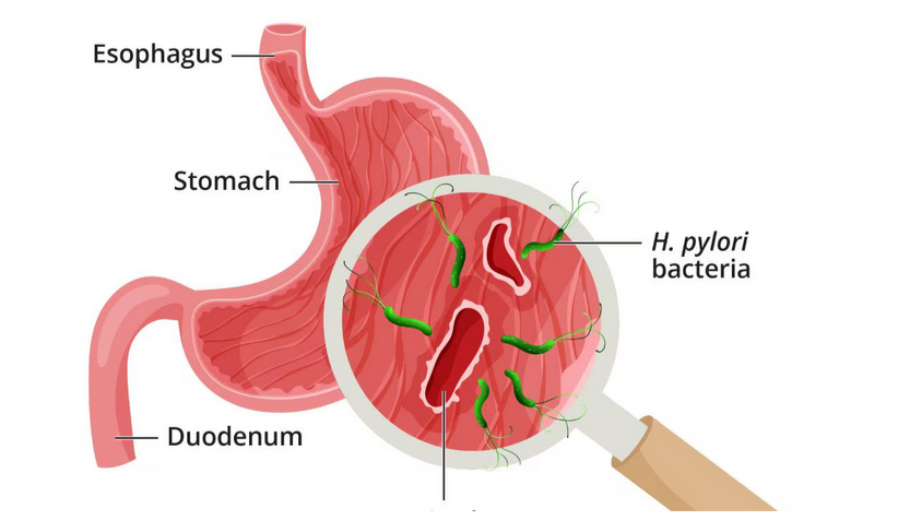 أسباب وعوامل خطر قرحة المعدة